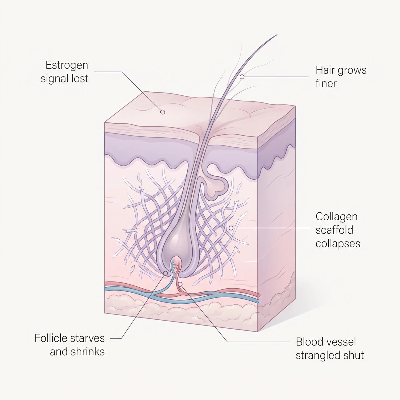 Diagram of a hair follicle after estrogen falls at menopause: collagen scaffold collapsing, blood vessel strangled shut, follicle starving